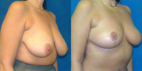 Breast Reduction Before and After Patient 104 3
