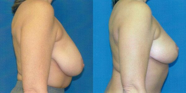 Breast Reduction Before and After Patient 104 2