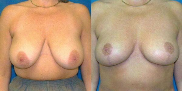 Breast Reduction Before and After Patient 104