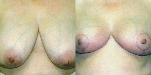 Breast Reduction Before and After Patient 106 2