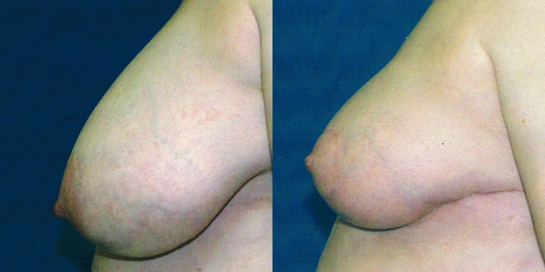 Breast Reduction Before and After Patient 105 2