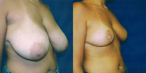 Breast Reduction Before and After Patient 106