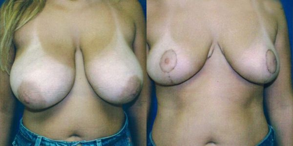 Breast Reduction Before and After Patient 106 1