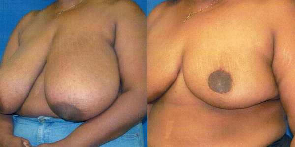 Breast Reduction Before and After Patient 107 2
