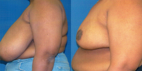 Breast Reduction Before and After Patient 107 (3)