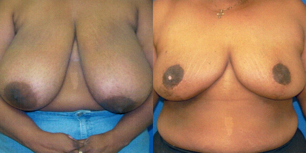 Breast Reduction Before and After Patient 107 1