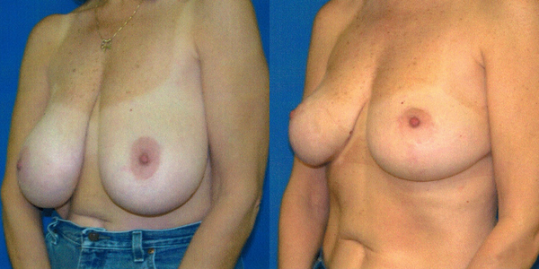 Breast Reduction Before and After Patient 108 2