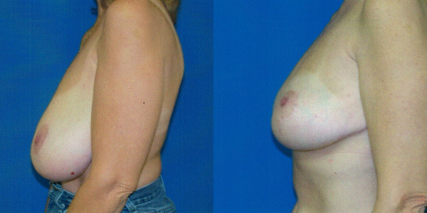 Breast Reduction Before and After Patient 108