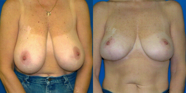 Breast Reduction Before and After Patient 108 3