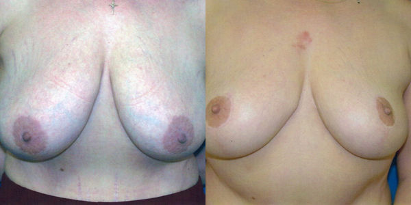 Breast Reduction Before and After Patient 109