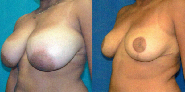 Breast Reduction Before and After Patient 110 2