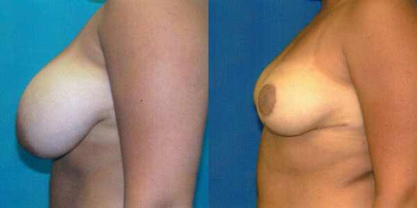 Breast Reduction Before and After Patient 110