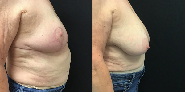 Breast Reduction Before and After Patient 167 3