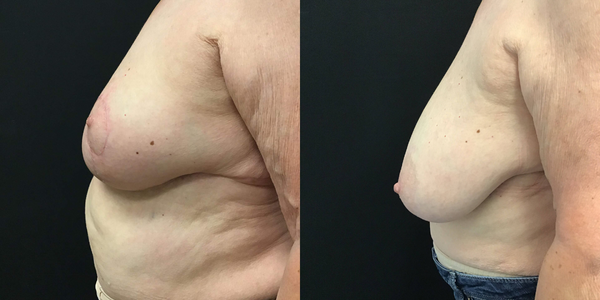 Breast Reduction Before and After Patient 167 2