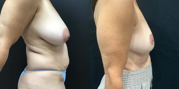Breast Reduction Before and After Patient 177 2