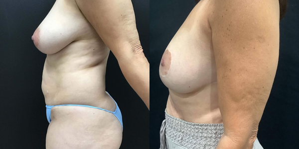 Breast Reduction Before and After Patient 177