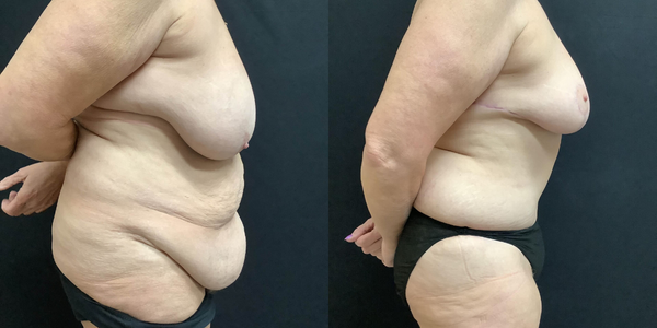Breast Reduction Before and After Patient 178 2