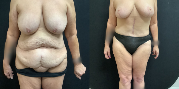 Breast Reduction Before and After Patient 178
