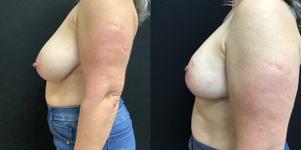 Breast Reduction Before and After Patient 184 2