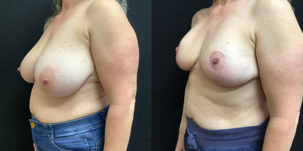 Breast Reduction Before and After Patient 184