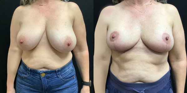 Breast Reduction Before and After Patient 184 5