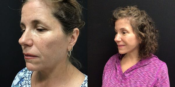 Brow Lift Before and After Patient 176 3