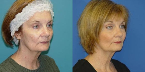 Brow Lift Before and After - Patient 8 2