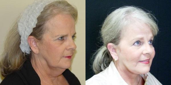 Brow Lift Before and After - Patient 94 2