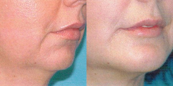 Chin Reshaping Before and After Patient 78 5