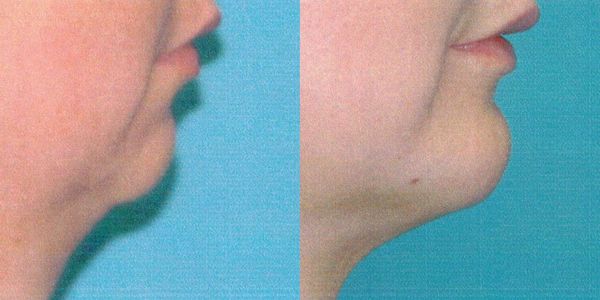 Chin Reshaping Before and After Patient 78 4