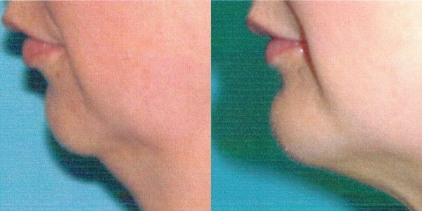 Chin Reshaping Before and After Patient 78 3