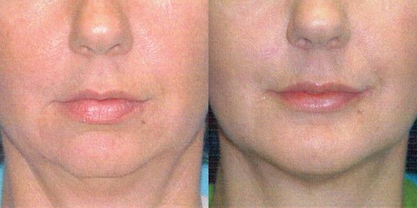 Chin Reshaping Before and After Patient 78