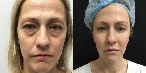 Eyelid Surgery Before And After Patient 189
