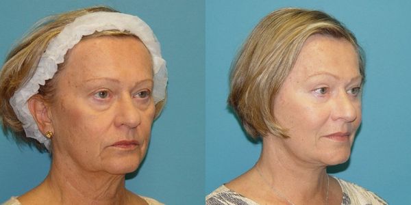 Eyelid Surgery Before And After Patient 2 3