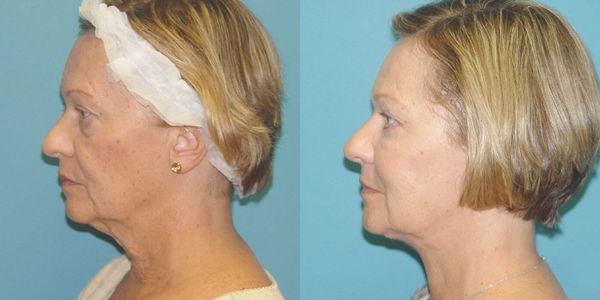 Eyelid Surgery Before And After Patient 2 2