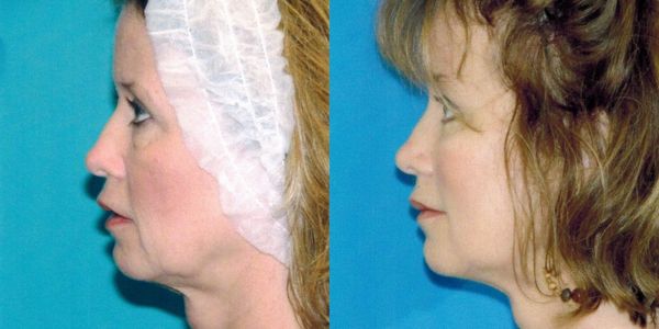 Eyelid Surgery Before And After Patient 7 4