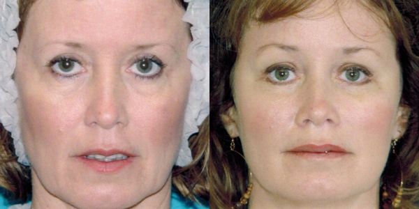 Eyelid Surgery Before And After Patient #7 (3)