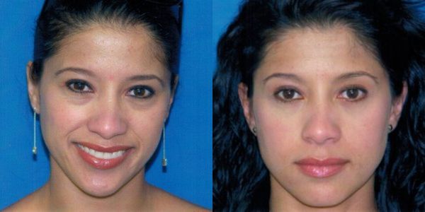 Eyelid Surgery Before And After Patient 81