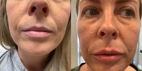 Lip Augmentation Before and After Patient 157 2