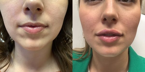Lip Augmentation Before and After Patient 157