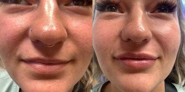 Lip Augmentation Before and After Patient 159