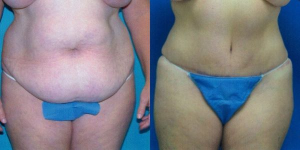 Liposuction Before and After Patient 135 3