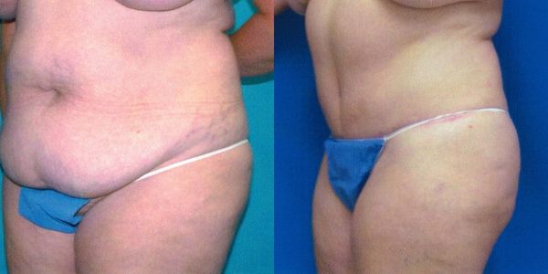 Liposuction Before and After Patient 135 2