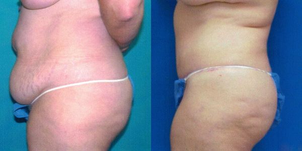 Liposuction Before and After Patient 135