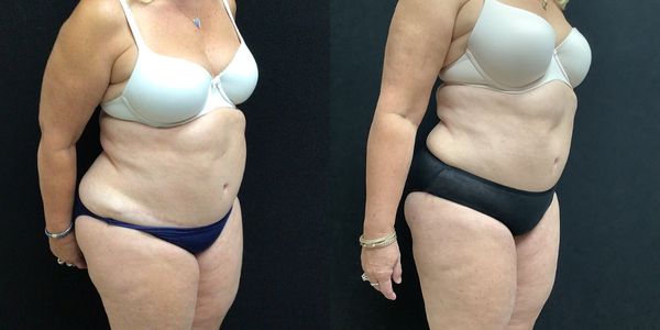 Liposuction Before and After Patient 143 3
