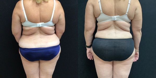 Liposuction Before and After Patient 143 2