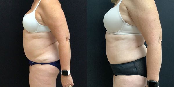 Liposuction Before and After Patient 143