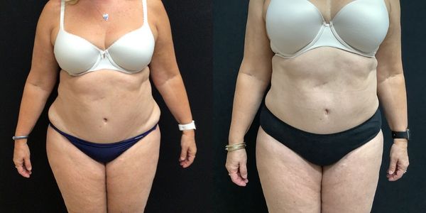 Liposuction Before and After Patient 143 4