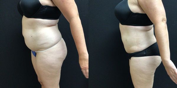 Liposuction Before and After Patient 144 2