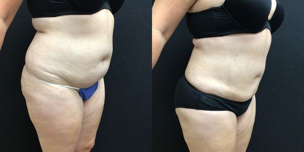 Liposuction Before and After Patient 144